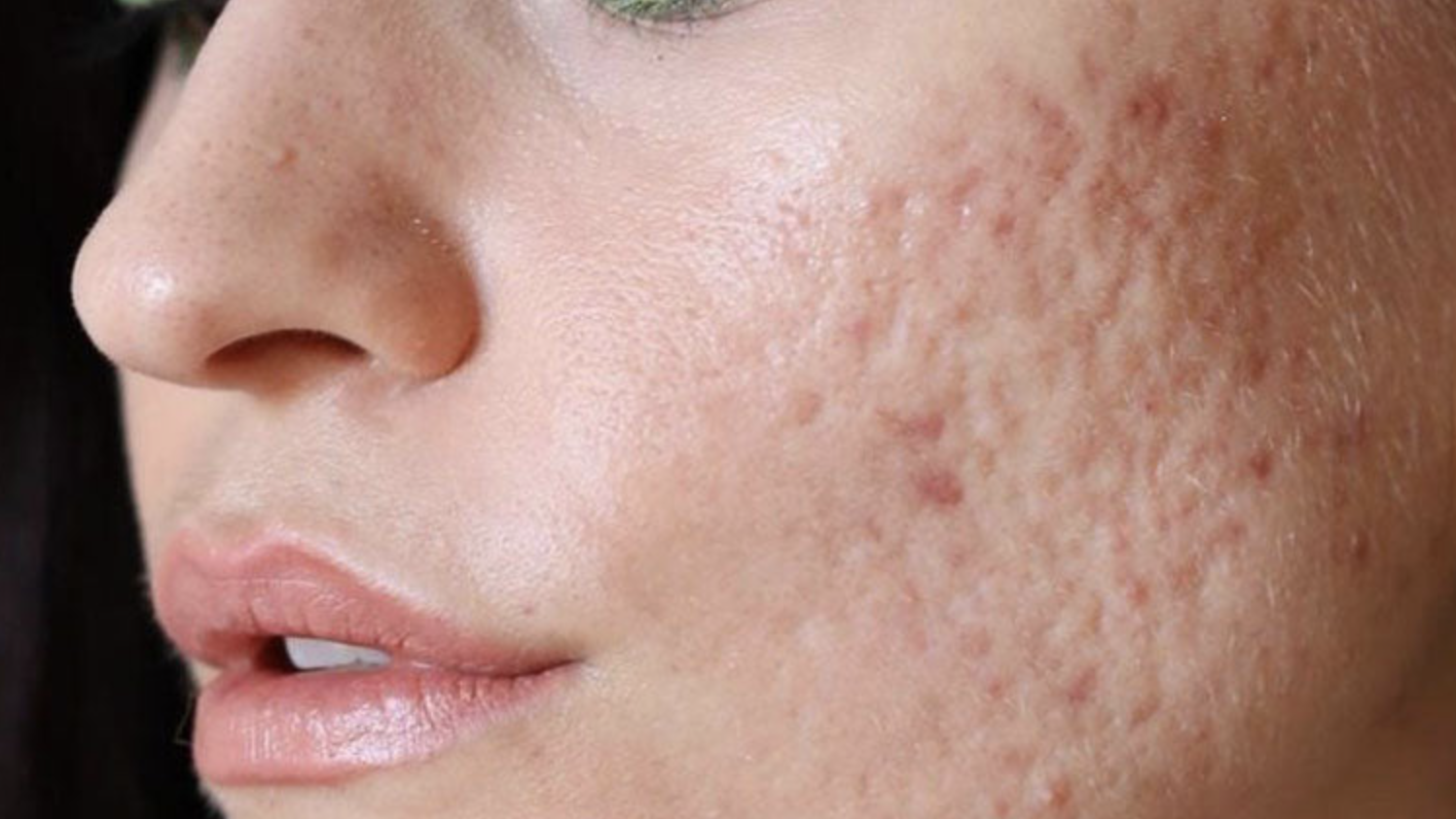 Acne Scarring